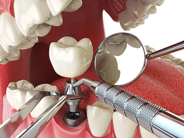 Best Emergency Dental Care for Broken or Chipped Teeth in Calhoun Falls, SC
